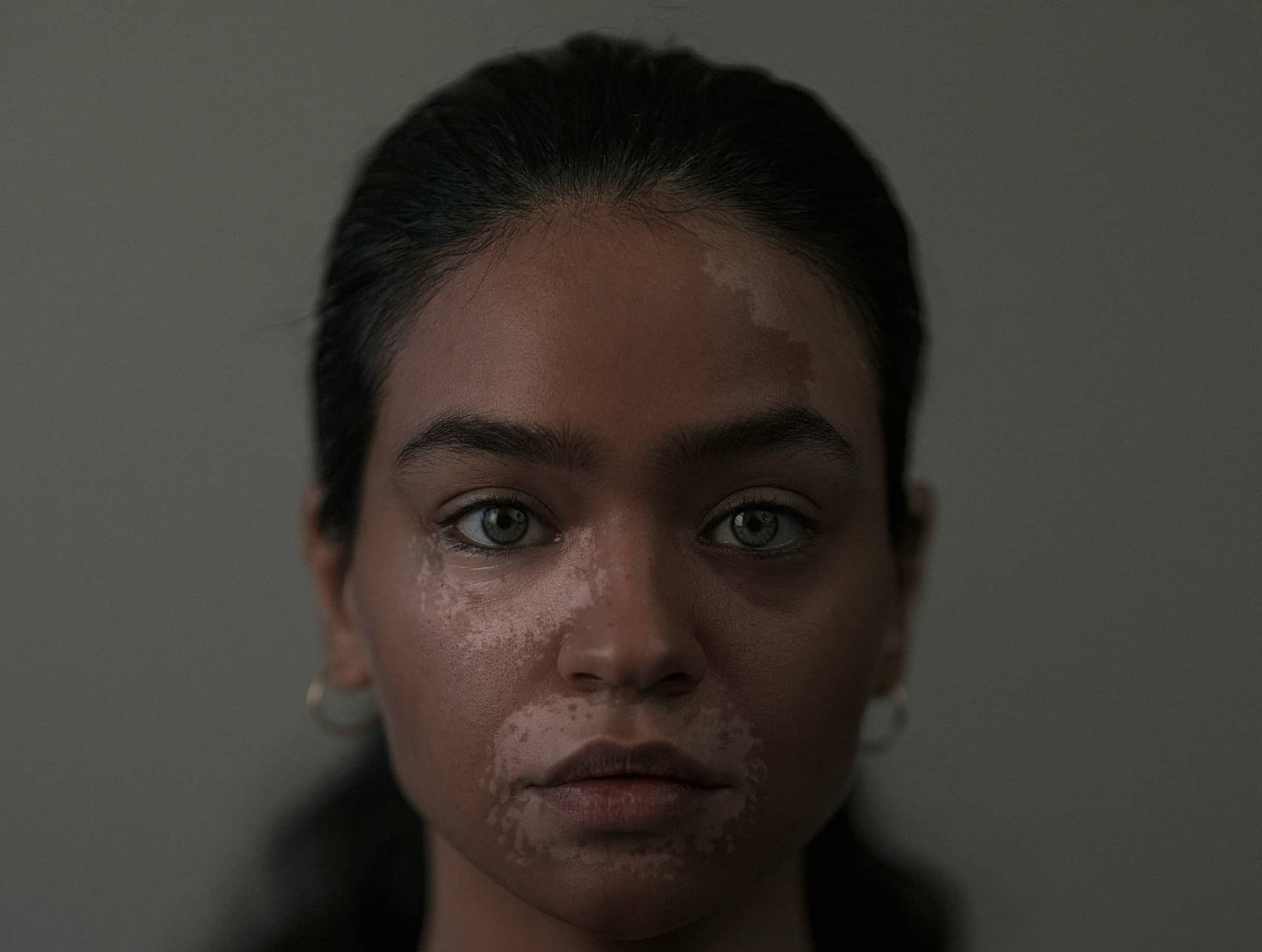 Can Vitiligo Affect Eyesight Pigment Loss And Vision The Vit Pro